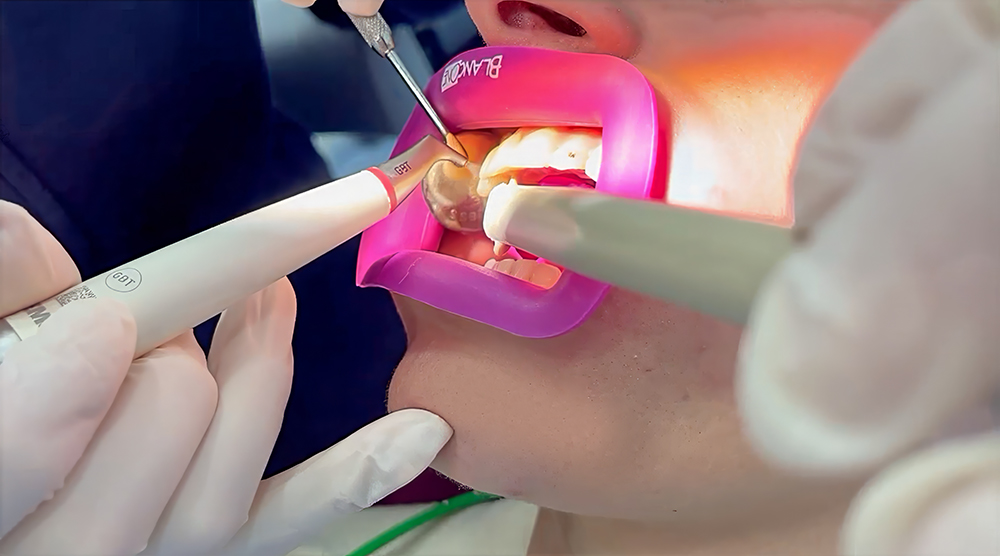 SCALER DENTALE SONICO elettrico rimozione placca tartaro pulizia denti